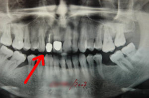 Ryc.1 zdjęcie rtg. pacjenta , czerwona strzałka wskazuje rozchwiany ząb przeznaczony do ekstrakcji
