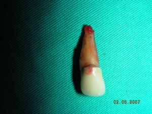 Ryc.2 usunięty ząb pacjenta